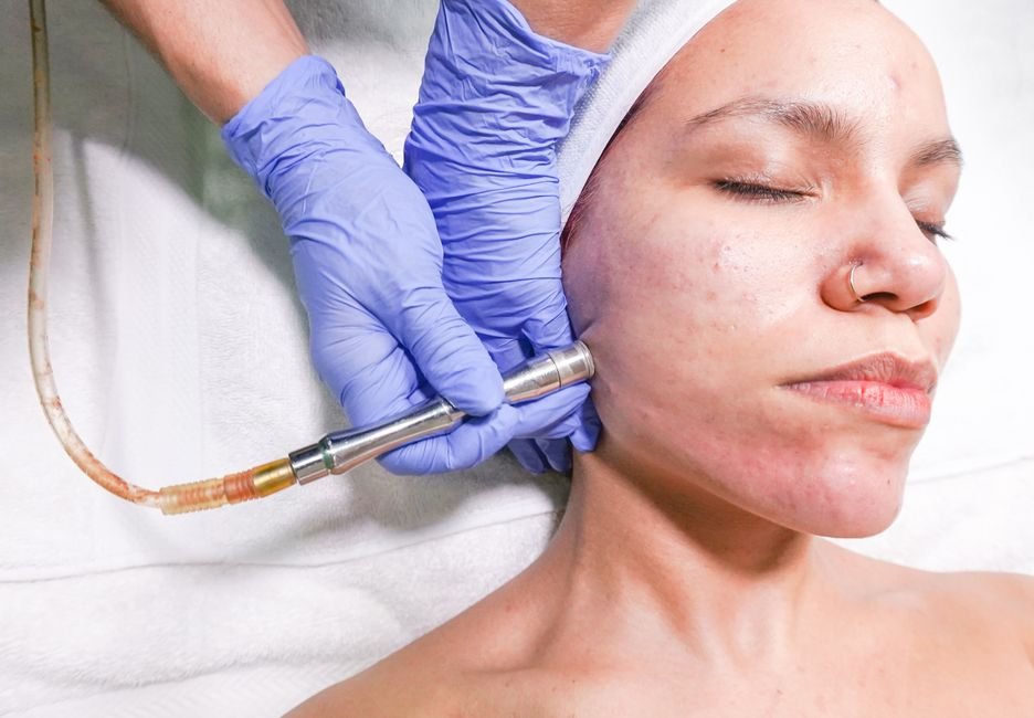 Dermabrasion / Microdermabrasion